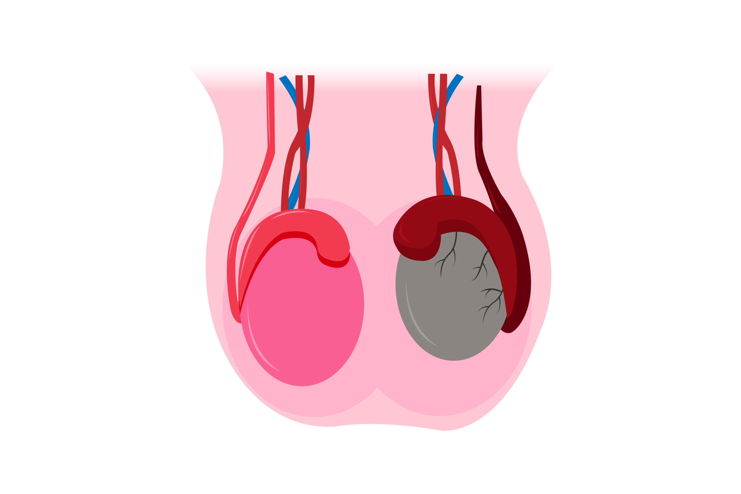 Testicular Cancer Treatment in Jaipur